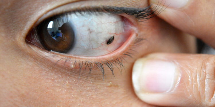 Akių apgamas (nevusas): tipai, priežastys ir gydymas