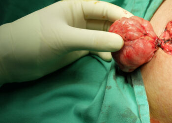 Krūties fibroadenoma: simptomai, gydymas ir šalinimas