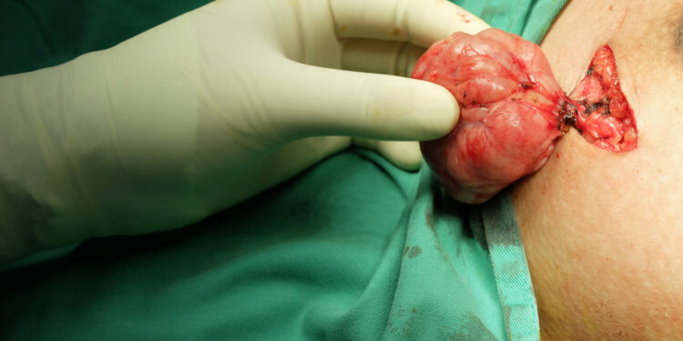 Krūties fibroadenoma: simptomai, gydymas ir šalinimas