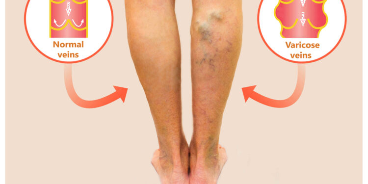 Mikroskopinis poliangitas (MPA): simptomai, priežastys, tyrimai ir gydymas