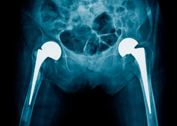 Išnarinis klubas: simptomai, gydymas ir sveikimas