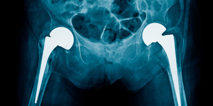 Išnarinis klubas: simptomai, gydymas ir sveikimas