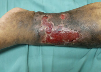 Heparino sukelta trombocitopenija: simptomai ir gydymas