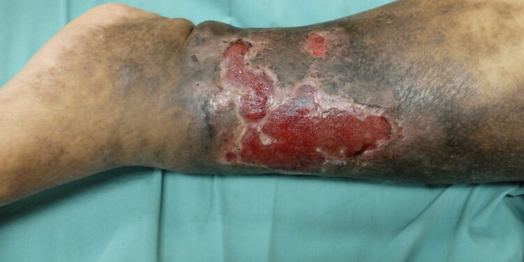 Heparino sukelta trombocitopenija: simptomai ir gydymas