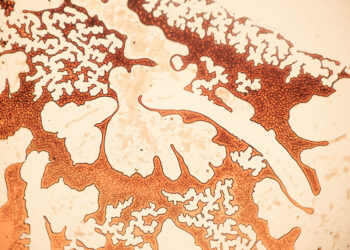 Granulocitozė: simptomai, priežastys ir gydymas