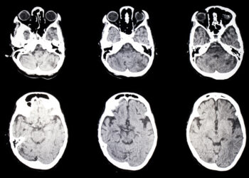 Menkeso liga: susisukę plaukai, vario trūkumas, pakaušio rago sindromas