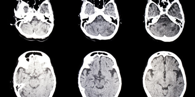 Menkeso liga: susisukę plaukai, vario trūkumas, pakaušio rago sindromas