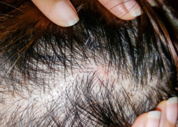 Lichen Planopilaris: plaukų slinkimas, simptomai ir gydymas