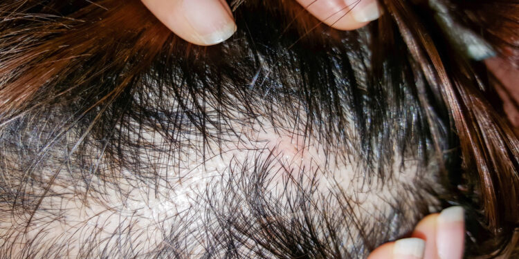 Lichen Planopilaris: plaukų slinkimas, simptomai ir gydymas