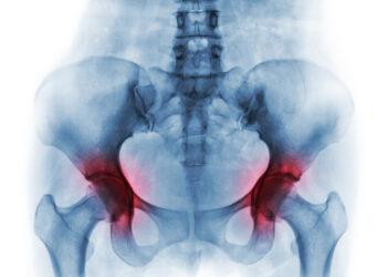 Osteoradionekrozė (ORN): Priežastys, simptomai ir gydymas