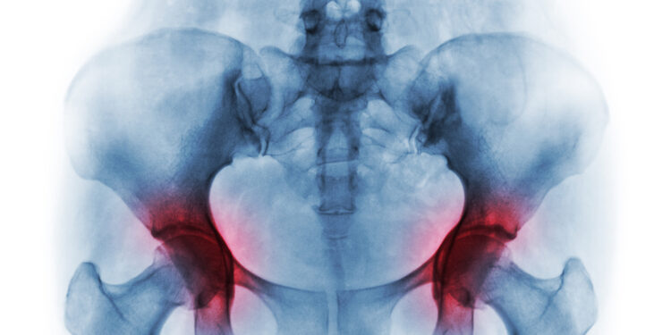 Osteoradionekrozė (ORN): Priežastys, simptomai ir gydymas