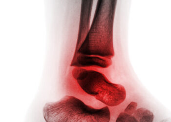 Vaikų idiopatinio artrito (VIA) simptomai, priežastys ir gydymas