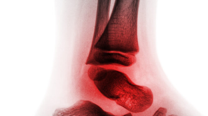 Vaikų idiopatinio artrito (VIA) simptomai, priežastys ir gydymas