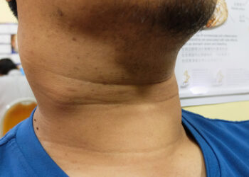 Papiliarinis skydliaukės vėžys (PSV): simptomai ir gydymas