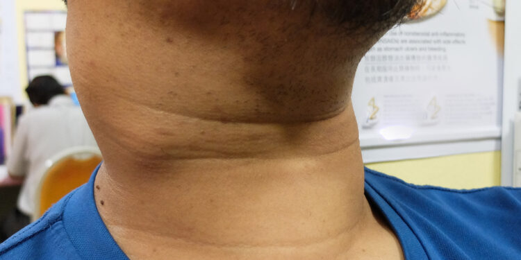 Papiliarinis skydliaukės vėžys (PSV): simptomai ir gydymas