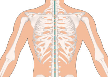 Pectus carinatum: priežastys ir gydymo būdai (krūtinės ląstos deformacija)
