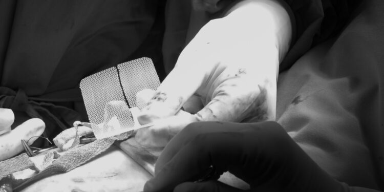 Pooperacinė išvarža: kas tai, simptomai ir gydymas