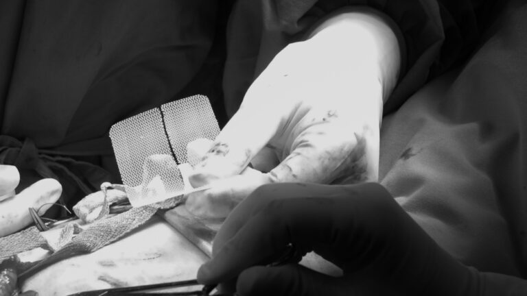 Pooperacinė išvarža: kas tai, simptomai ir gydymas