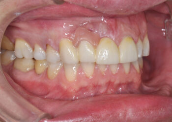 Leukoplakija: Priežastys, simptomai ir gydymas