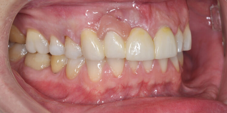 Leukoplakija: Priežastys, simptomai ir gydymas