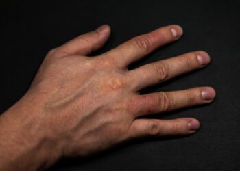 Perioralinio dermatito gydymas, simptomai ir priežastys