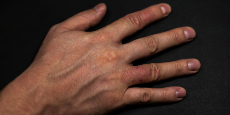 Perioralinio dermatito gydymas, simptomai ir priežastys