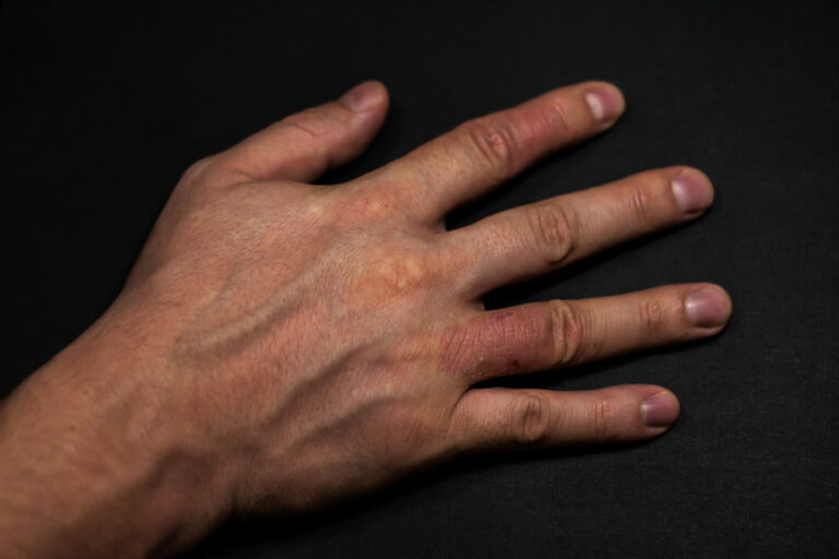 Perioralinio dermatito gydymas, simptomai ir priežastys