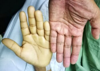 Blyškumas: Priežastys, diagnostika ir gydymas