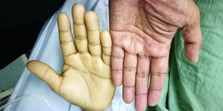 Blyškumas: Priežastys, diagnostika ir gydymas