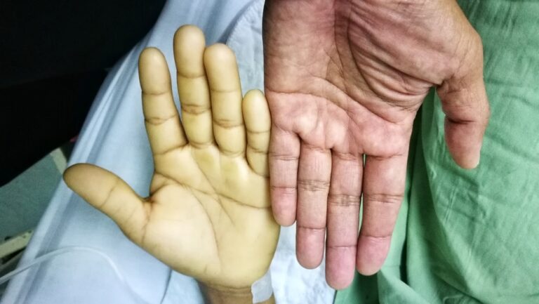 Blyškumas: Priežastys, diagnostika ir gydymas