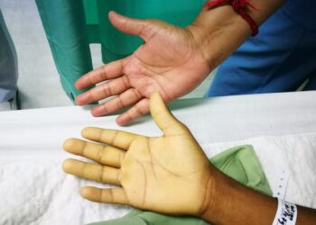 Ar dažnai gydoma hiatinė išvarža, jei pacientas serga anemija?