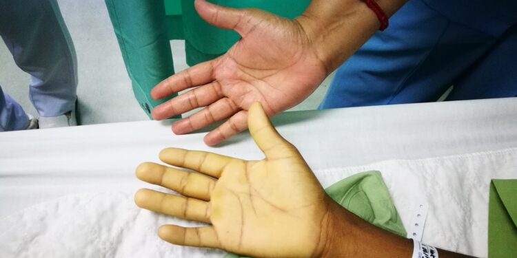 Ar dažnai gydoma hiatinė išvarža, jei pacientas serga anemija?