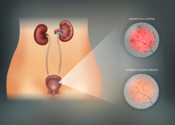 Kraujuojantis cistitas: priežastys, simptomai ir gydymas