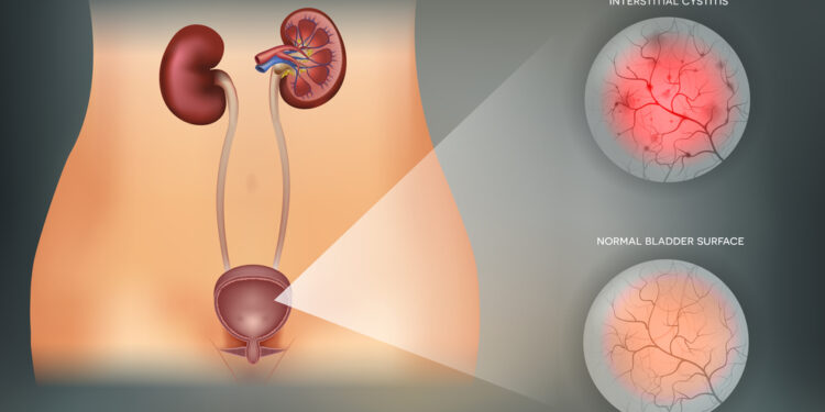 Kraujuojantis cistitas: priežastys, simptomai ir gydymas