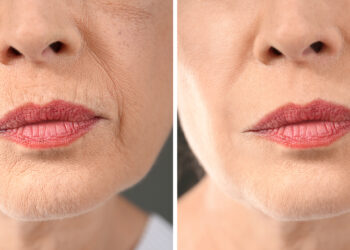 Lūpų raukšlelės: vertikalūs lūpų raukšlėjimaisi, priežastys, užpildai ir kiti gydymo būdai