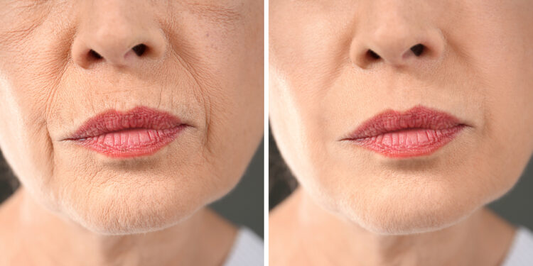 Lūpų raukšlelės: vertikalūs lūpų raukšlėjimaisi, priežastys, užpildai ir kiti gydymo būdai
