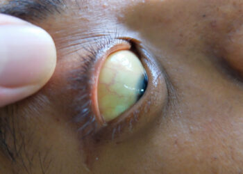 Kernikterus: kas tai, priežastys, simptomai ir gydymas