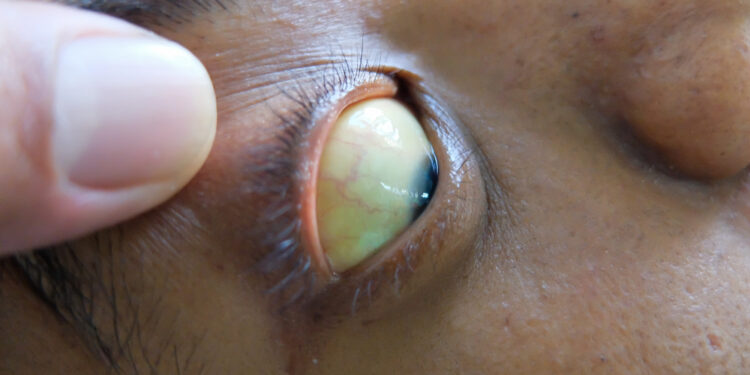 Kernikterus: kas tai, priežastys, simptomai ir gydymas