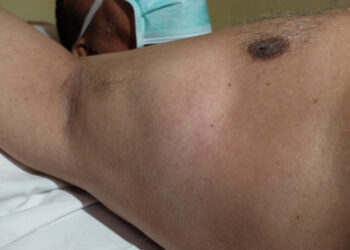 Pažasties limfmazgių grupė