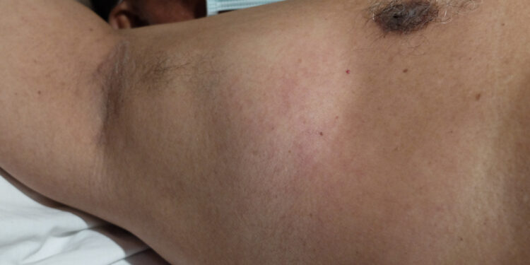 Pažasties limfmazgių grupė