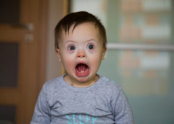 Hanterio sindromas (MPS II): simptomai ir priežastys