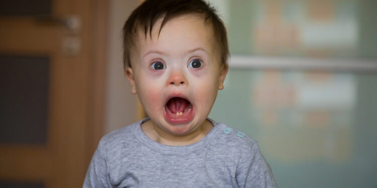 Hanterio sindromas (MPS II): simptomai ir priežastys