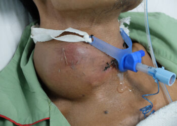 Lobulinė karcinoma in situ (LKIS)