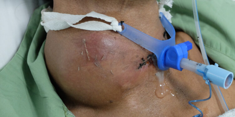 Lobulinė karcinoma in situ (LKIS)