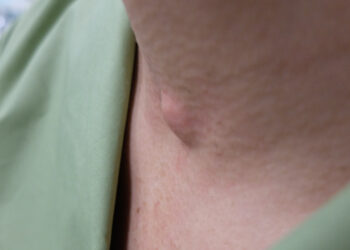 Kiaušidžių dermoidinė cista: priežastys, simptomai ir gydymas