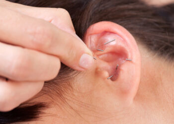 Ausies keloidas: kas tai, auskarų vėrimas, šalinimas, randai, keloidas už ausies