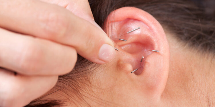 Ausies keloidas: kas tai, auskarų vėrimas, šalinimas, randai, keloidas už ausies