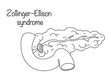 Viskas, ką reikia žinoti apie Zollingerio-Ellisono sindromą ir vėžį