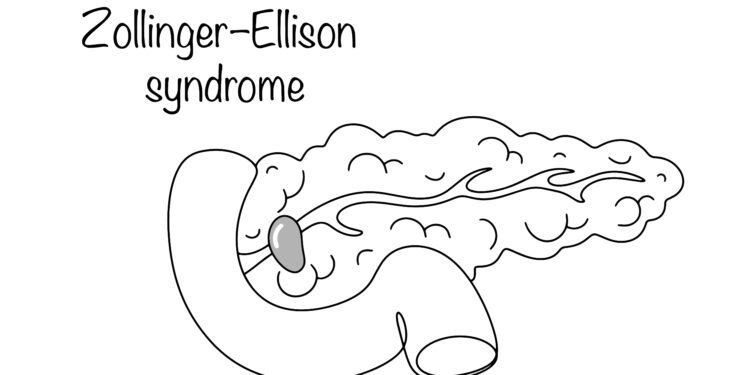 Viskas, ką reikia žinoti apie Zollingerio-Ellisono sindromą ir vėžį