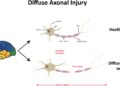 Difuzinis aksonų pažeidimas